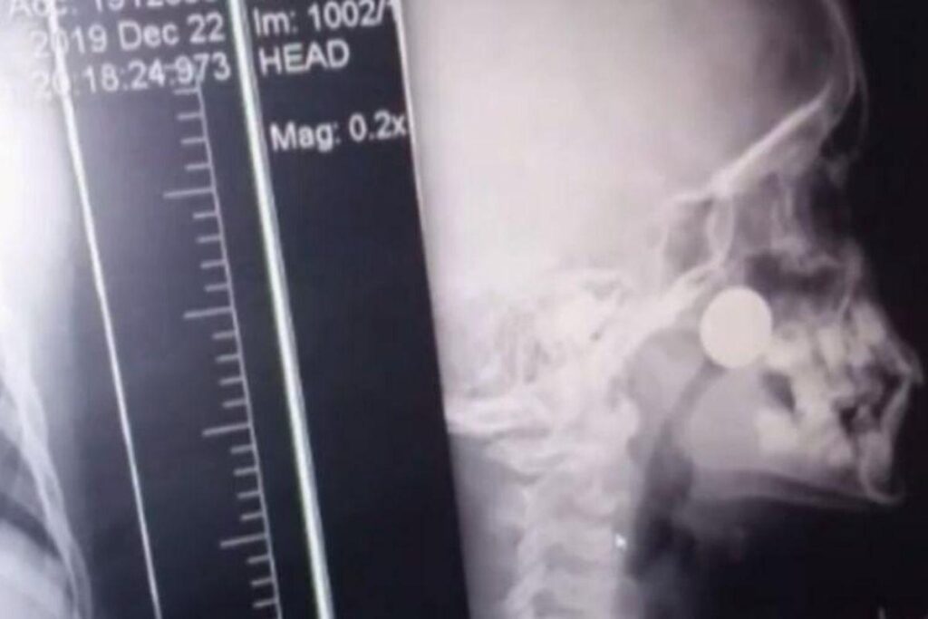 Ele quase passou por uma cirurgia