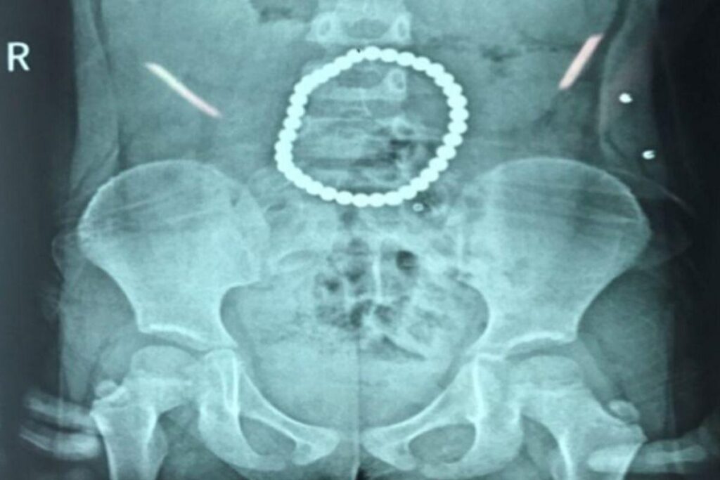 A menina precisou passar por uma cirurgia reparadora