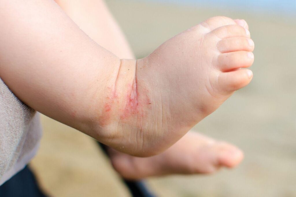 A menina foi levada com febre para o hospital