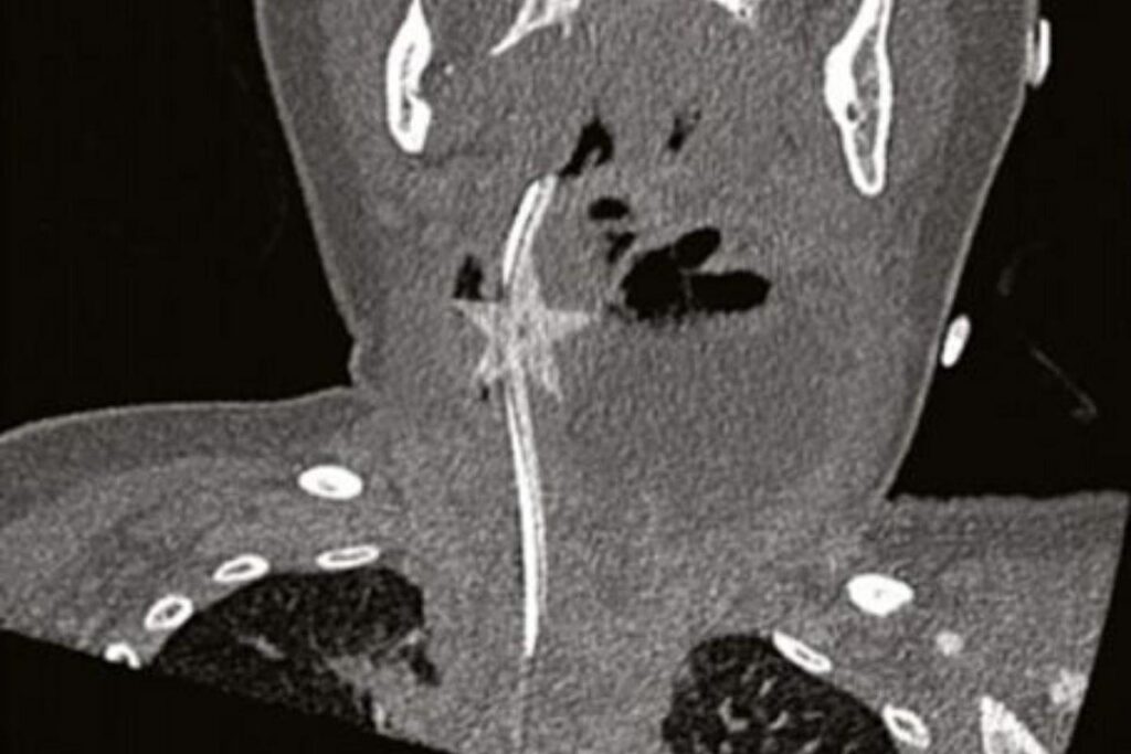 Ela engoliu uma estrela de plástico