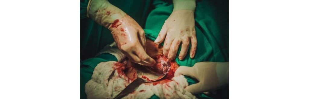 Miguel aparece com a mão para fora antes de ser tirado da barriga da mãe