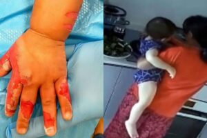 A babá queimou a mão do bebê de propósito