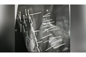 Menino pisa em tábua com mais de 28 pregos