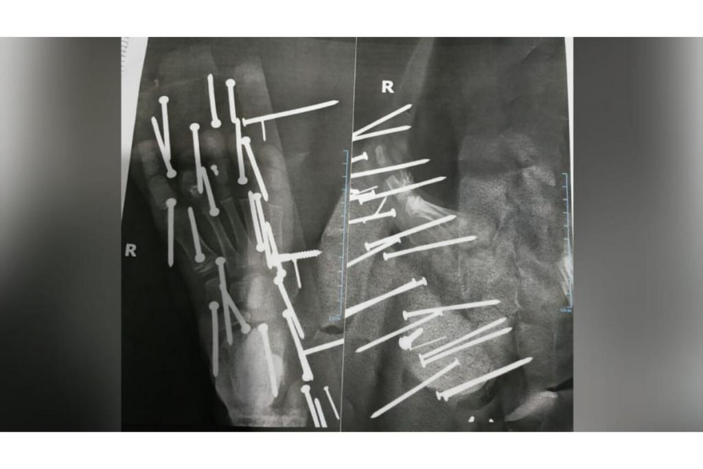 Menino pisa em tábua com mais de 28 pregos