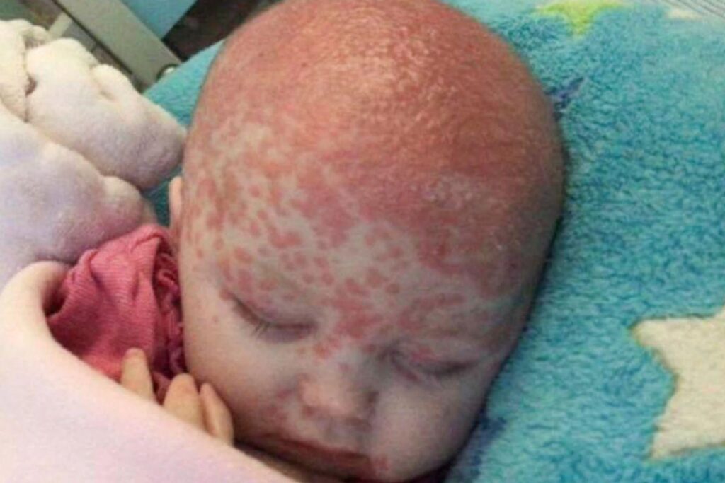 Garota de apenas 6 meses pega herpes através do toque