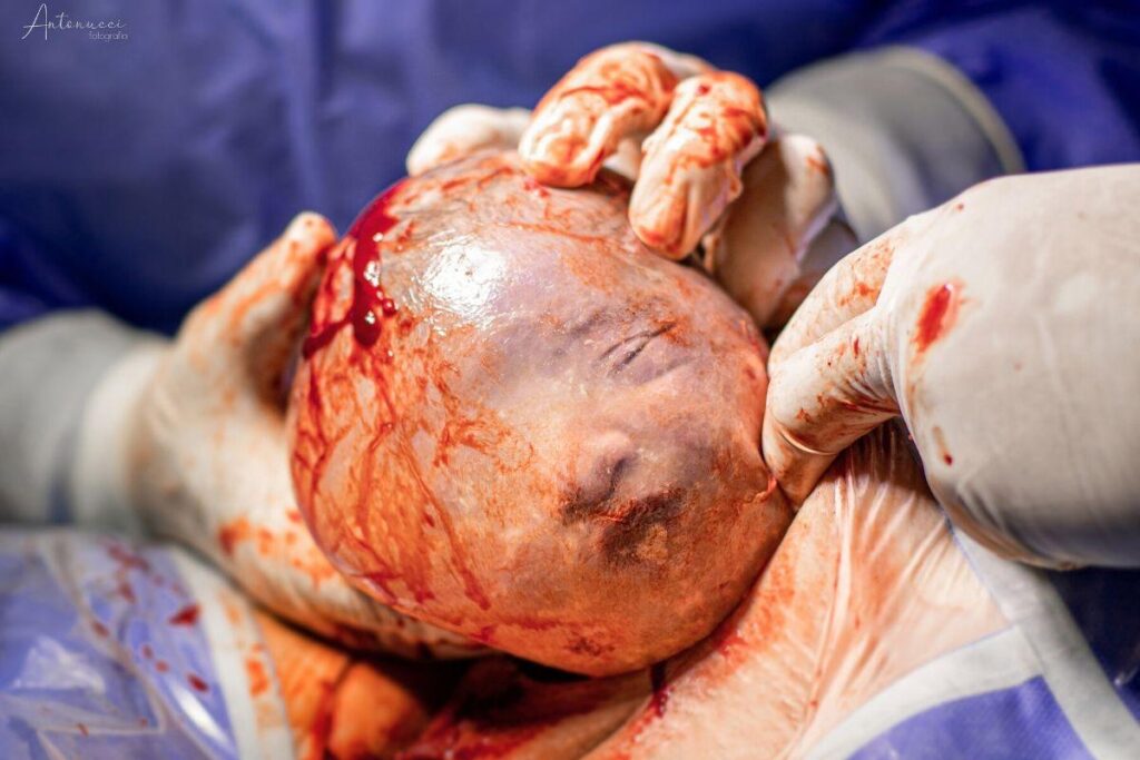 Em seu 10° parto, fotógrafa consegue capturar parto empelicado