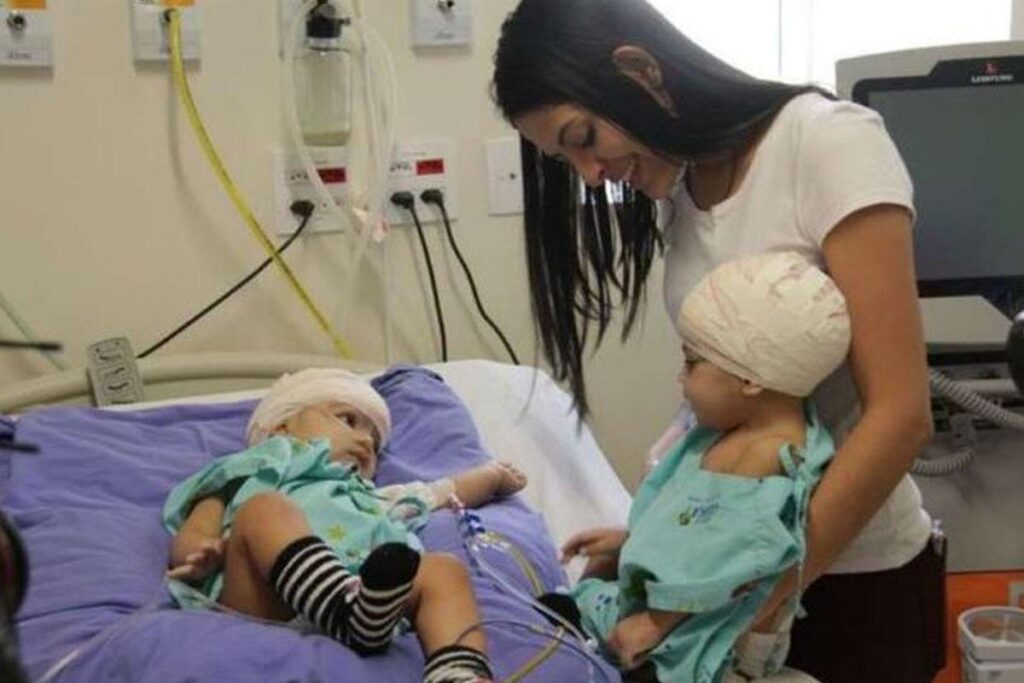 Gêmeas siamesas Lis e Mel comemoram 1 ano de cirurgia