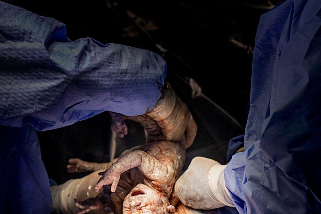 Bebê nasce com uma coroa formada pelo cordão umbilical e foto impressiona