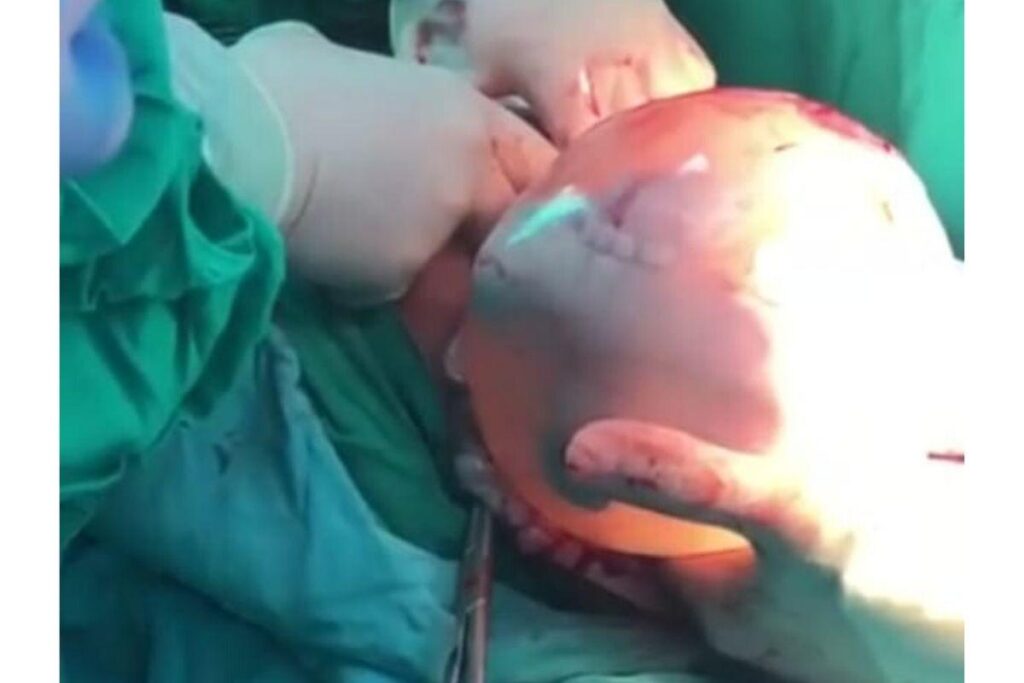 Mensagem que fala que parto empelicado aconteceu devido ao coronavírus é fake