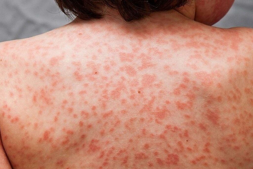 Eles acreditavam que esta inflamação era parecida com a doença de Kawasaki