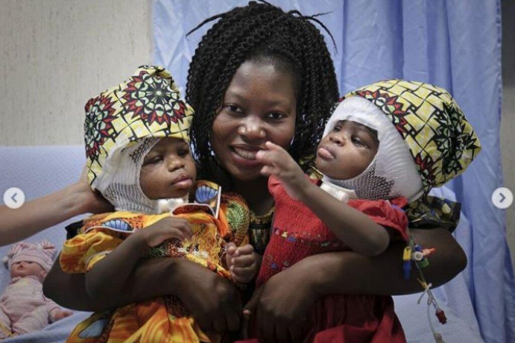 A cirurgia levou 18 horas e contou com a ajudade de 30 profissionais