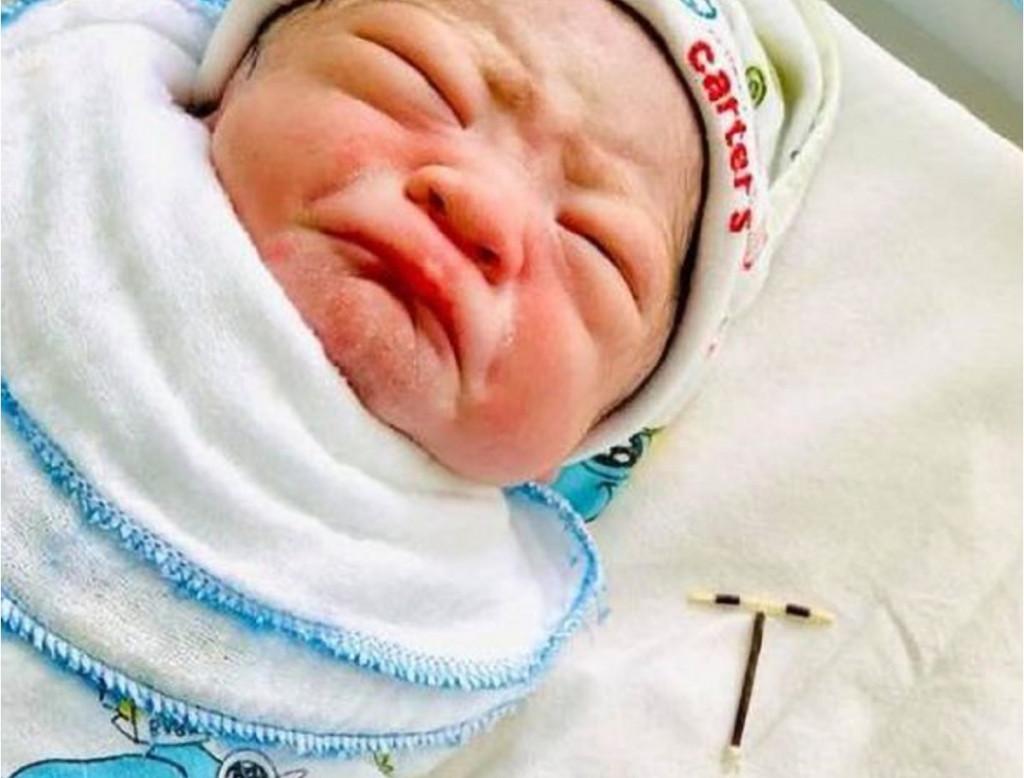 Ao sair da barriga da mãe, o menino segurava o dispositivo intrauterino