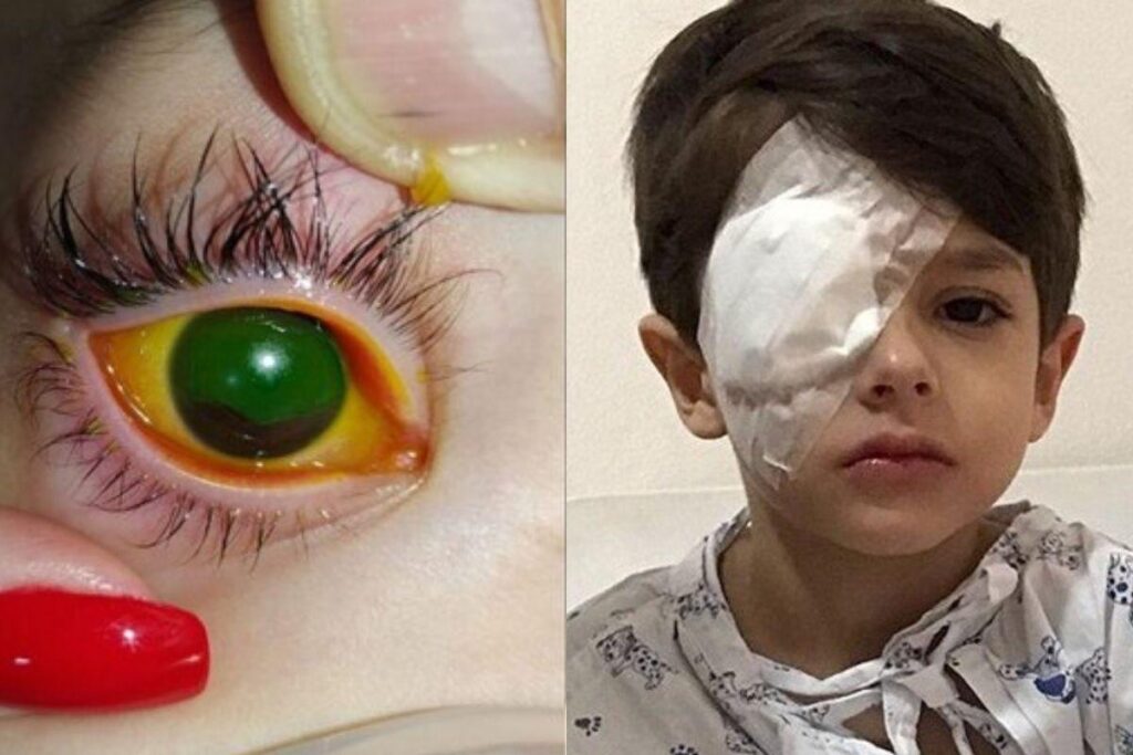 Menino sofre lesão devido ao álcool em gel