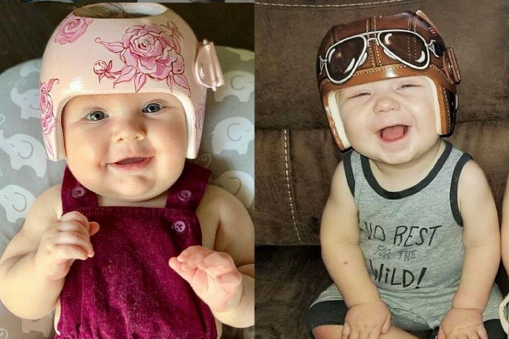 Artista transforma capacetes usados ​​por bebês com síndrome em arte