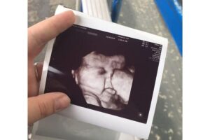 O tamanho do cabelo da garota impressionou os médicos