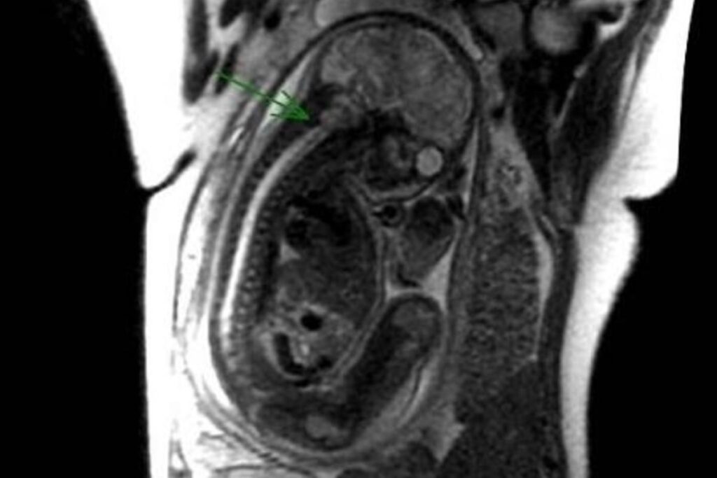 O bebê tinha uma malformação na coluna vertebral