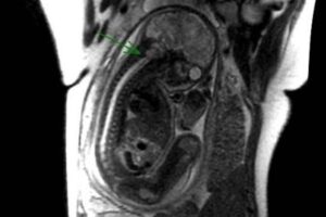 O bebê tinha uma malformação na coluna vertebral