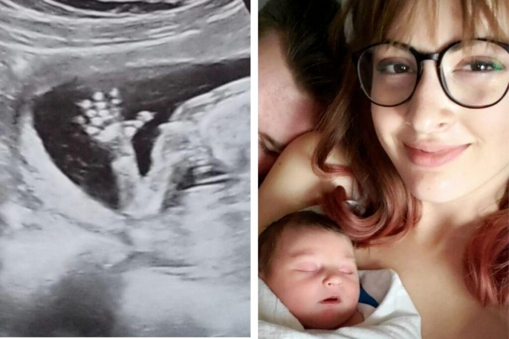 A professora tem ‘utério Didelfo’