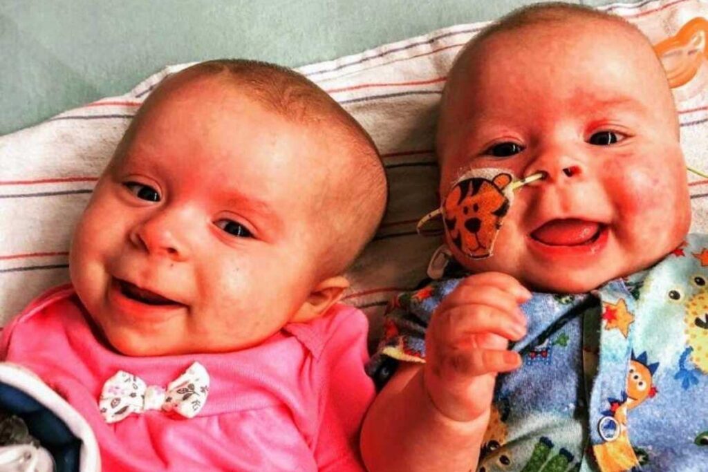 As irmãs receberam o diagnóstico com 1 mês de idade