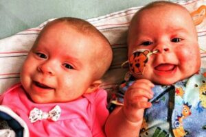 As irmãs receberam o diagnóstico com 1 mês de idade