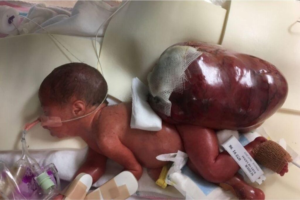 A bebê sobreviveu ao parto e a UTI