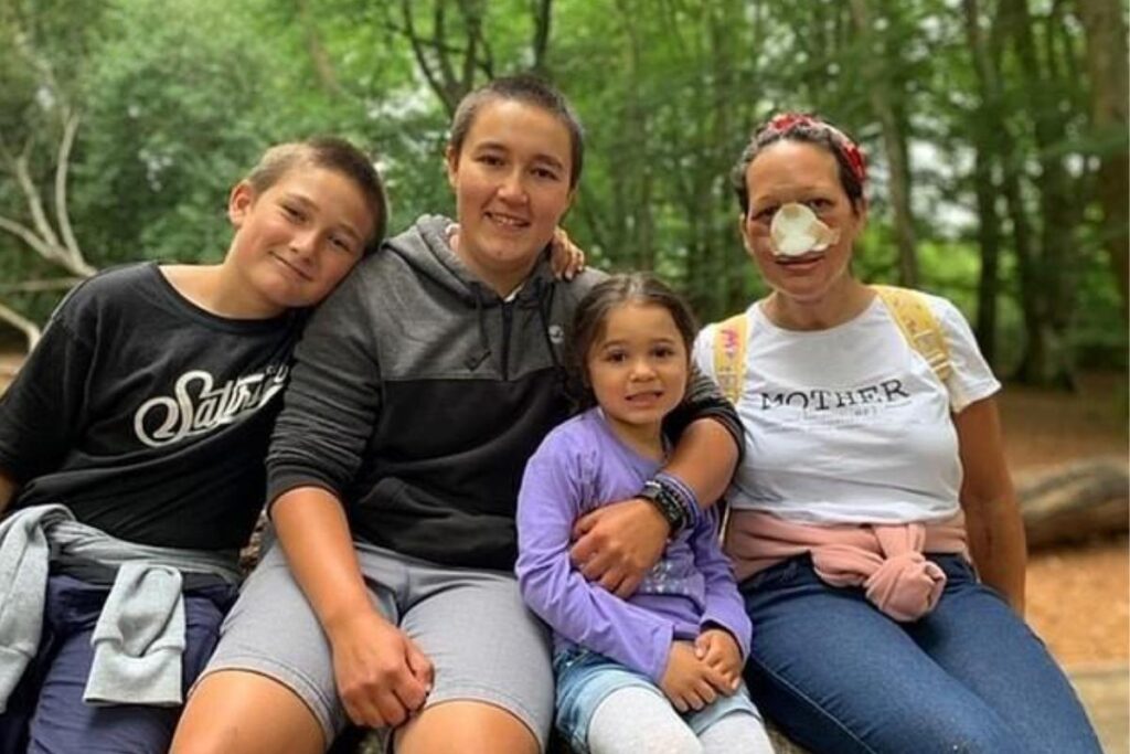 Durante quimioterapia, o nariz de Julia triplicou de tamanho. A única solução encontrada pelos médicos foi a remoção completa