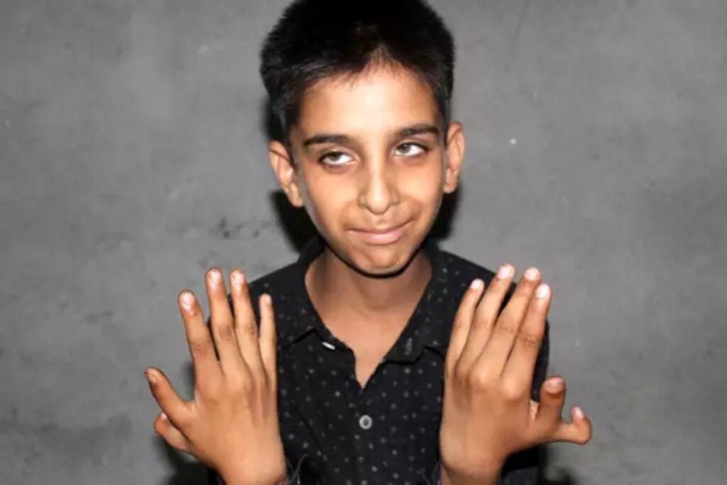 O menino nasceu com dois polegares extras e diz que eles o ajudam a jogar videogame