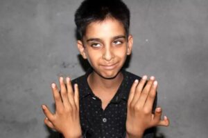 O menino nasceu com dois polegares extras e diz que eles o ajudam a jogar videogame