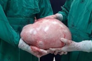 O tumor pesa quase 20 kg