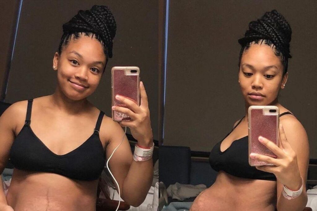 Mãe de três compartilha barriga pós-parto em fotos reais
