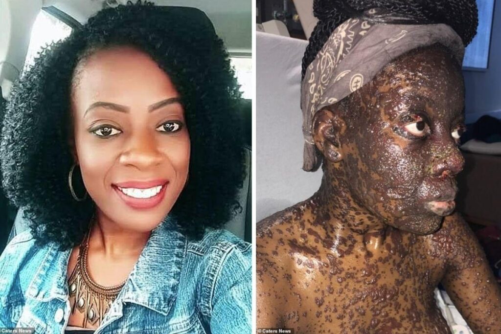 Rachel antes de sofrer a reação e ficar com a pele queimada