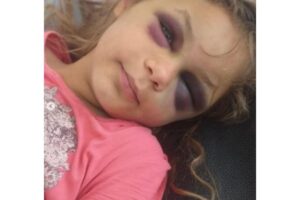 Ela sobreviveu a picada