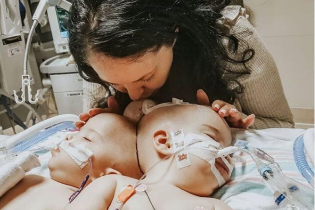 As irmãs nasceram unidas pela cabeça