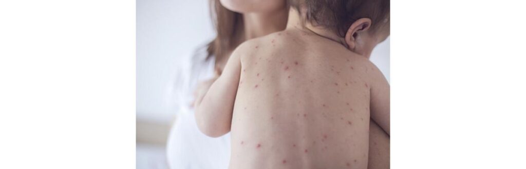 OMS fez um alerta para os casos de sarampo no mundo