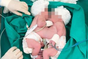 Tudo correu bem, mas elas estão em estado de observação