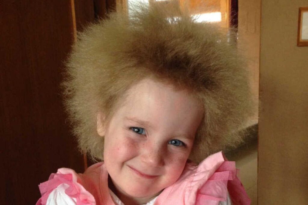 A menina sofre de uma alteração genética