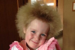 A menina sofre de uma alteração genética