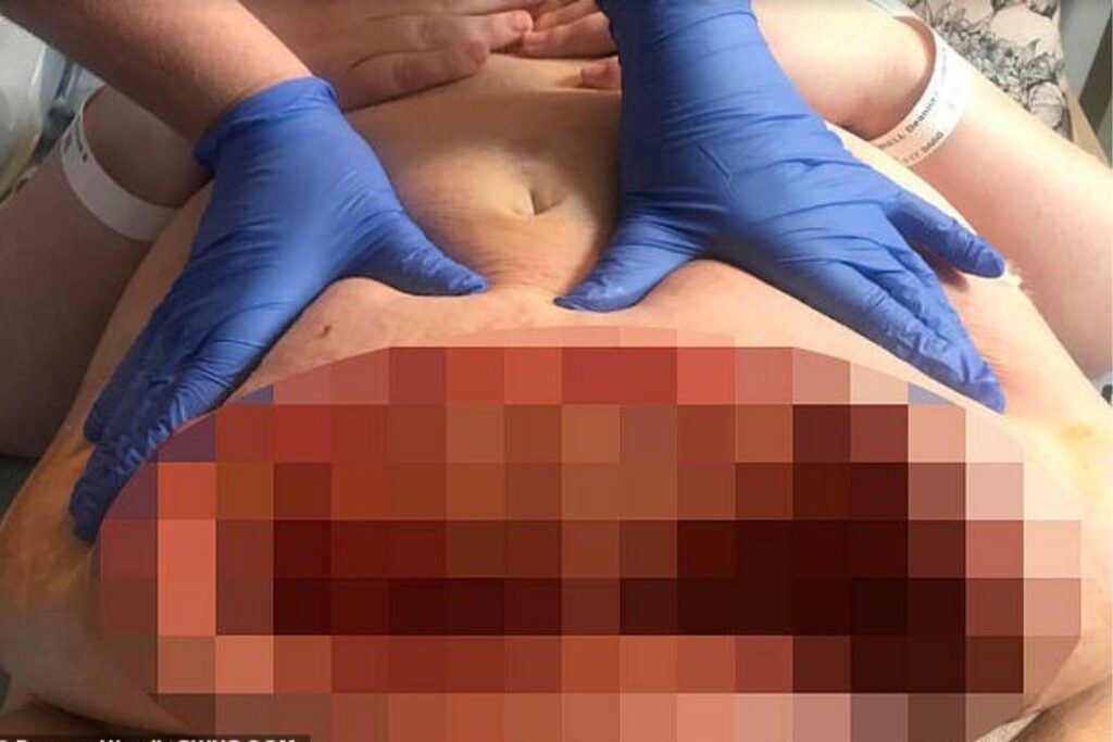 A mãe poderia ter perdido a vida, dizem os médicos