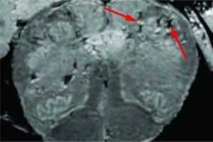 Apesar da doença ser considerada respiratória, alguns sintomas podem ser neurológicos