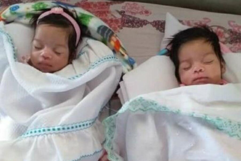 Mãe espera filhas acordarem do coma