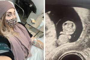 Grávida de gêmeos, mãe faz desabafo sobre aborto espontâneo de um dos bebês