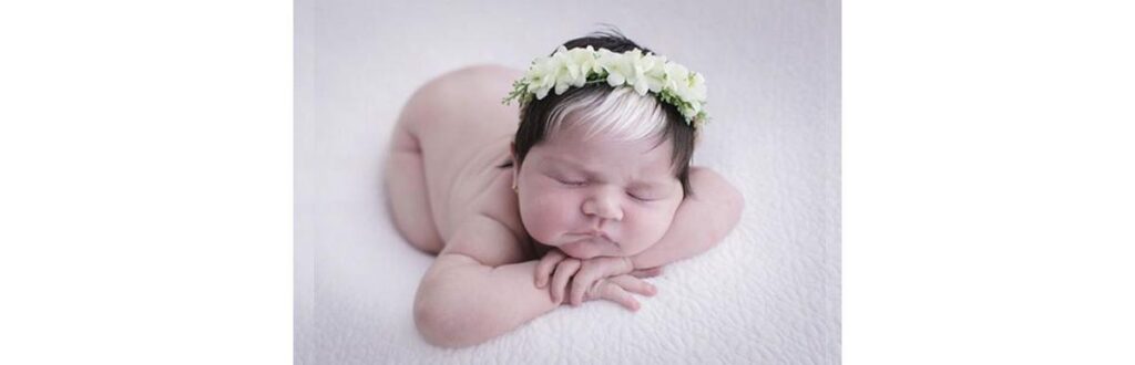 Mayah nasceu com a mesma condição da mãe, Talyta: as duas tem piebaldismo