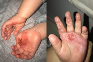 Catarina, de 9 meses, apoiou as mãos no forno e teve queimaduras de 2º grau