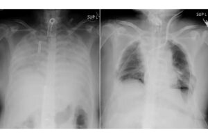 O primeiro transplante de pulmão com doadores vivos foi feito no Japão. O tórax de um paciente antes da cirurgia (à esquerda) e depois