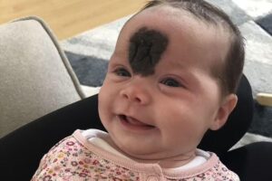 Vienna nasceu com marca de nascença entre os olhos e os pais estavam determinados em removê-la