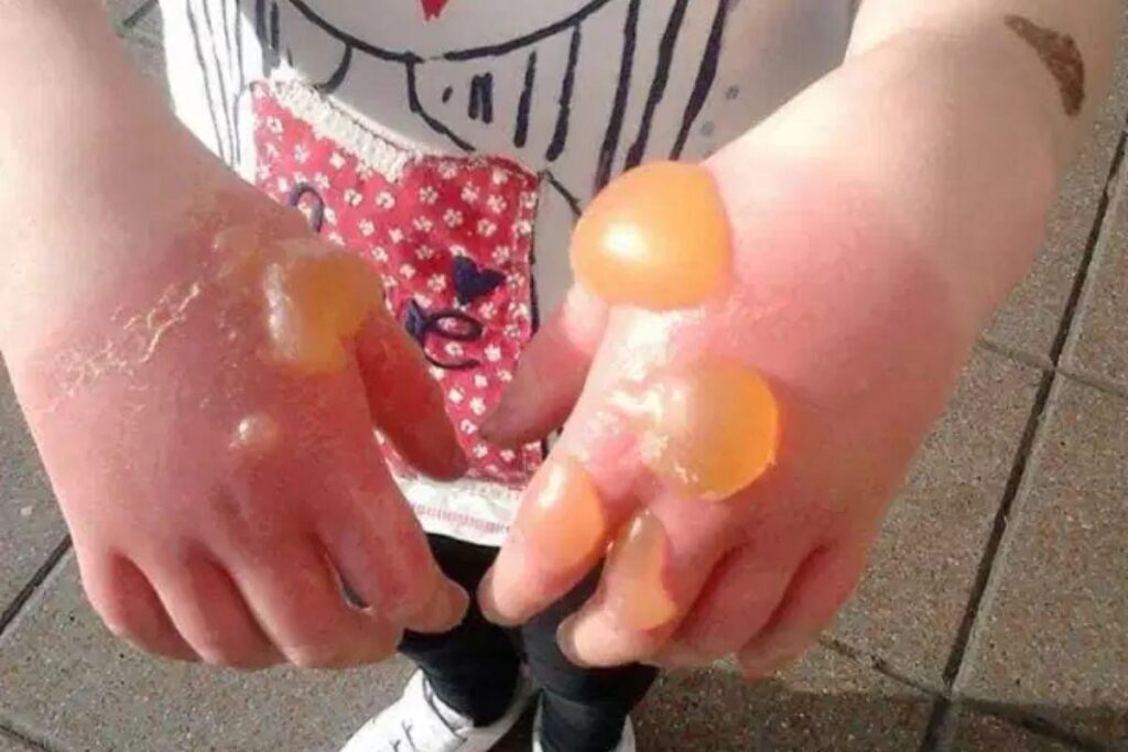 Menina fica com queimadura de terceiro grau ao entrar em contato com nogueira-gigante