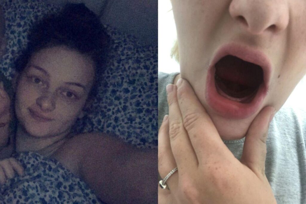 Louise sofreu com Hiperêmese gravídica