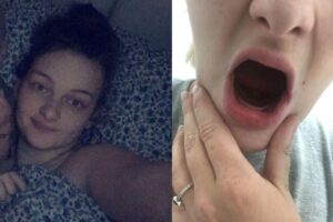 Louise sofreu com Hiperêmese gravídica