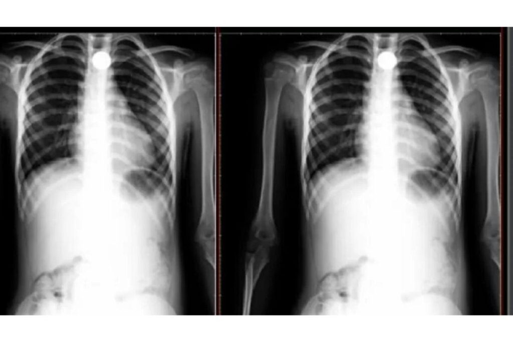 A asfixia é uma das principais causas de acidentes infantis