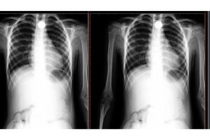 A asfixia é uma das principais causas de acidentes infantis